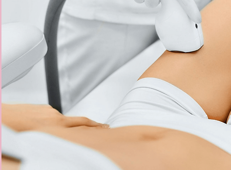laser hair removal almere